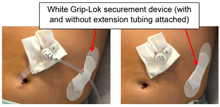 White Grip-Lok securement device (with and without extension tubing attached)