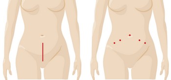 Endometriosis_Incision_Comparison
