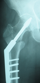 Dynamic Helical Hip System in an intertrochanteric fracture