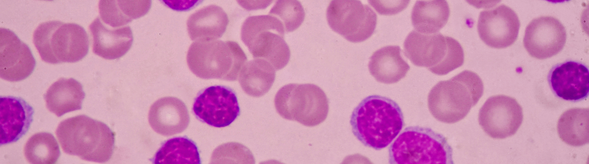 Leukemia Cells