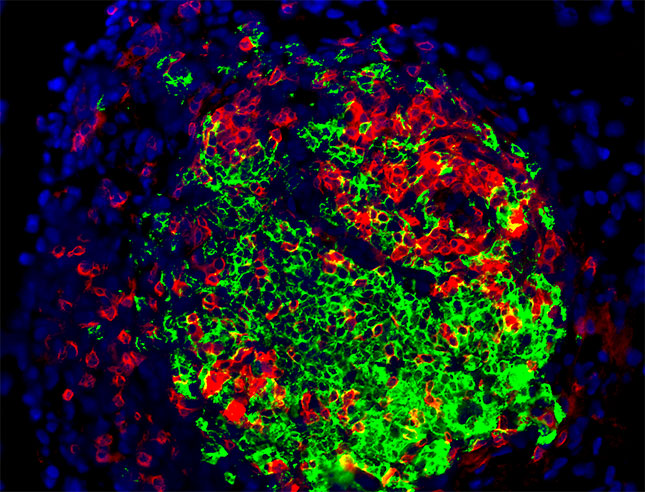 Synovium with inflammatory cells (CD3 in red and CD20 in green)