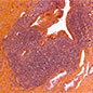 100x picture showing an ectopic lymphoid structure in prostate of individual with prostate intraepithelial neoplasia