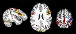 Language and motor networks from t-fMRI (yellow and blue) and rs-fMRI (red) in a patient with epilepsy