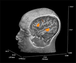 Pre-surgical language mapping with fMRI