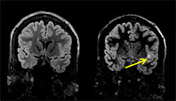 Cortical lesion in the mesial left temporal lobe  identified only on DIR (right) MRI and not on standard CUBE T2 FLAIR (left).