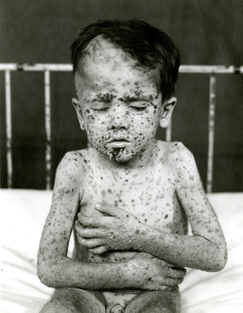 Child with chicken pox 1935
