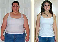 Jen's Before and After Success Story with Bariatric Surgery