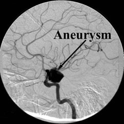 Coil Embolization of Aneurysm - Procedures - For Patients - Radiology - University of Rochester ...