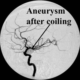 Aneurysm after Coiling