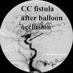 CC Fistula after balloon occlusion
