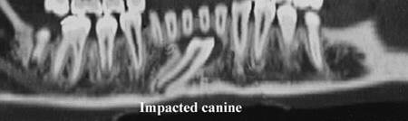 Impacted Canine