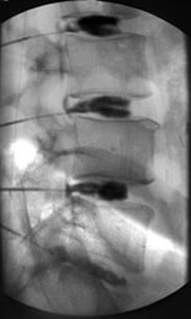 Lumbar discogram showcasing needles places in the cartilage