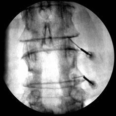 Side effects of epidural steroid injections in lumbar spine