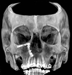 3D Reconstruction of the Skull