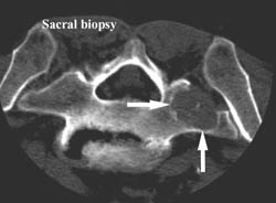 Sacral Biopsy