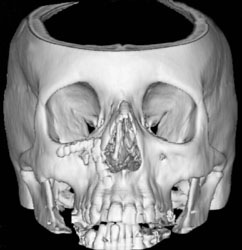 3D Reconstruction of the Skull showing Bone Density