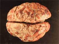 Figure 1: Gross examination reveals a purulent exudate over surface of brain