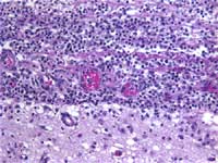 Figure 2: H & E stain shows acute and chronic inflammation along the leptomeninges (upper half) of the brain (lower half)