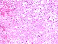 Figure 4:  H & E stain of liver shows areas of necrosis