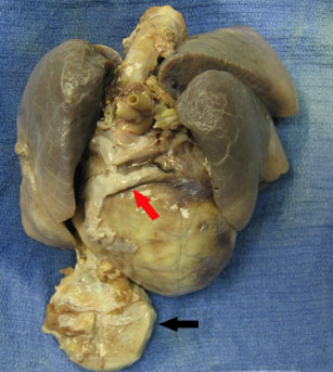 Photo of heart and lungs after autopsy