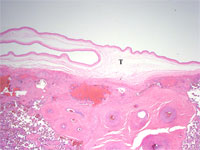 Figure 1a: The T-zone (T) of a monochorionic diamnionic placenta