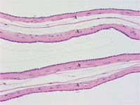 Figure 1b: The amnion layers (A) of a monochorionic diamnionic placenta