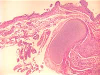 Figure 1: Lumbrosacral myelomenigocele