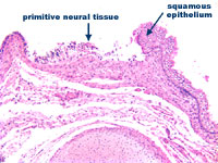 Figure 2:  Lumbrosacral myelomenigocele at higher power