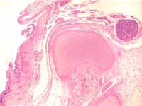Figure 3: Incomplete formation of vertebral body with primitive neural
                  tissue in continuity with squamous epithelium. Higher power
                  below.