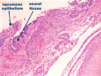 Figure 4: Incomplete formation of vertebral body with primitive neural tissue in continuity with squamous epithelium at higher power