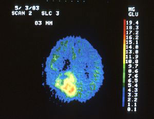 photo of brain tumor
