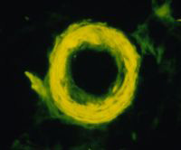 image of amyloid deposit in human brain