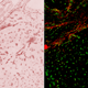 Picture of Implanted prostate tumor