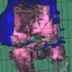 Inflammatory-Erosive Arthritis, Arthritic Flare, and Bone Marrow Edema
