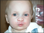 infant after cleft lip and cleft palate repair