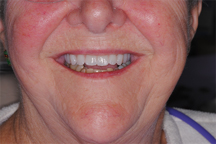 After  prosthodontic treatment