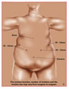 View incisions laproscopic incisions