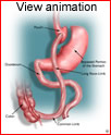 View Roux-en-Y Gastric Bypass Procedure