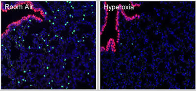 Effect of Neonatal Hyperoxia on Lung Development
