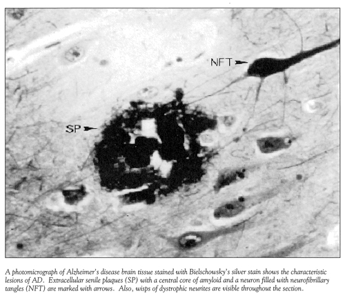 Photomicrogragh of an Alzheimer's brain cell