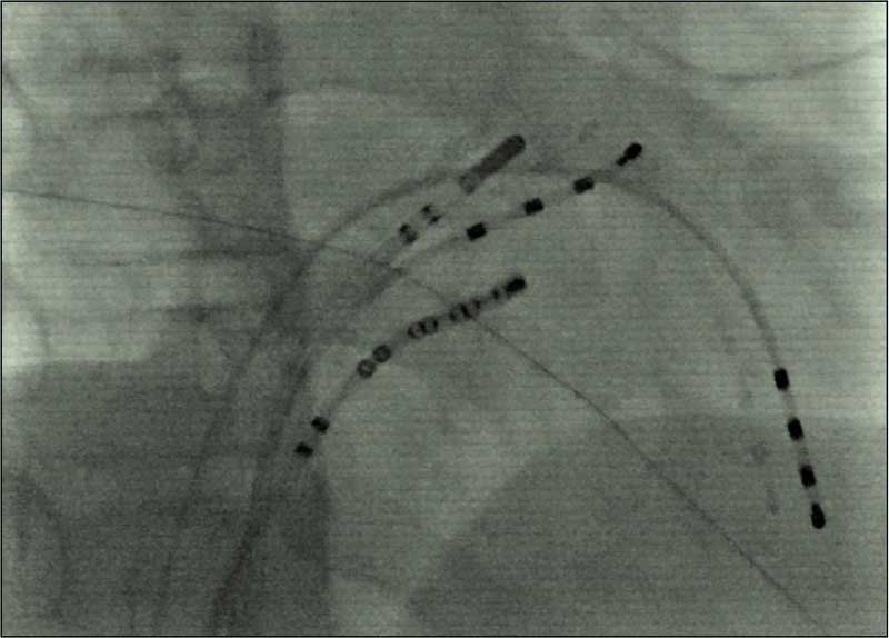 X-ray of catheters inside the heart 01