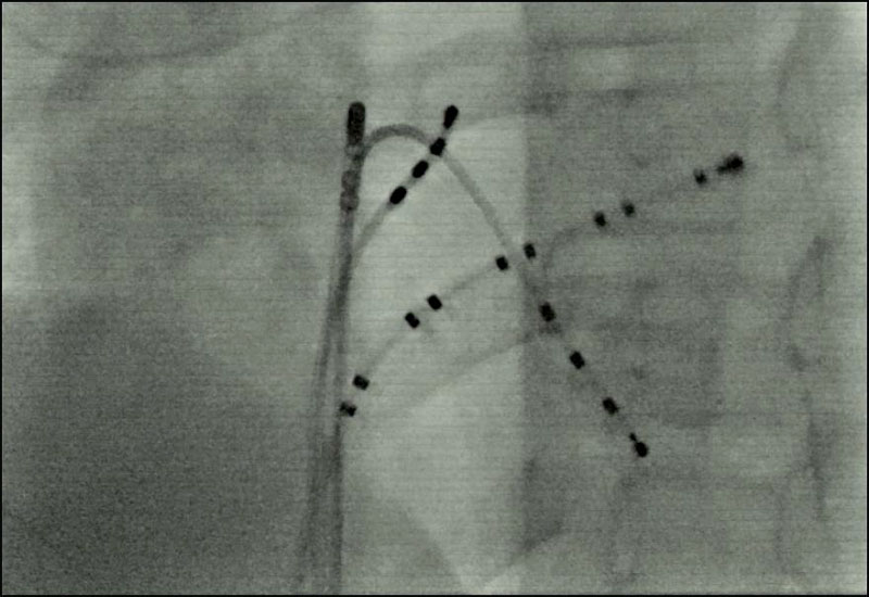 X-ray of catheters inside the heart 02