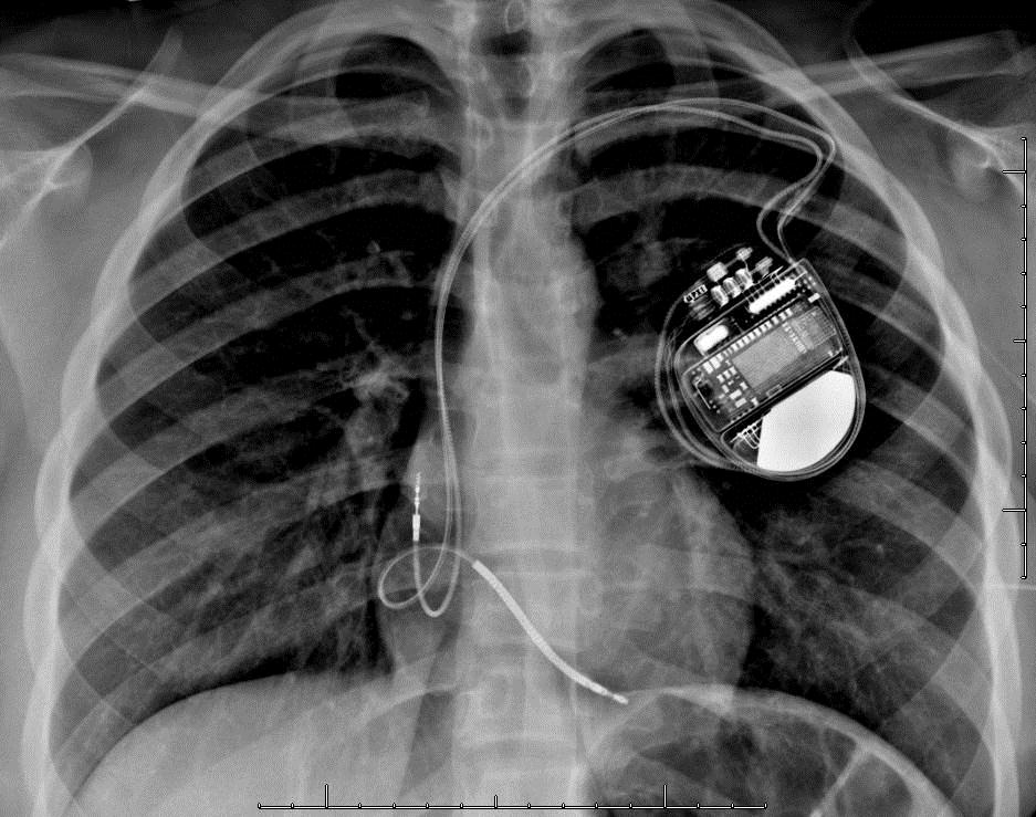 Chest X-ray of Pacemaker - Defibrillator Implantation