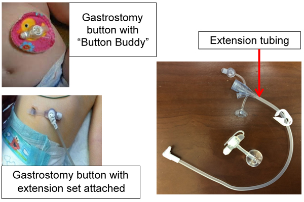 PEG: button buddy, extenxsion tubing