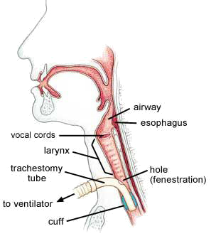 Trach - diagram of postion of a trach