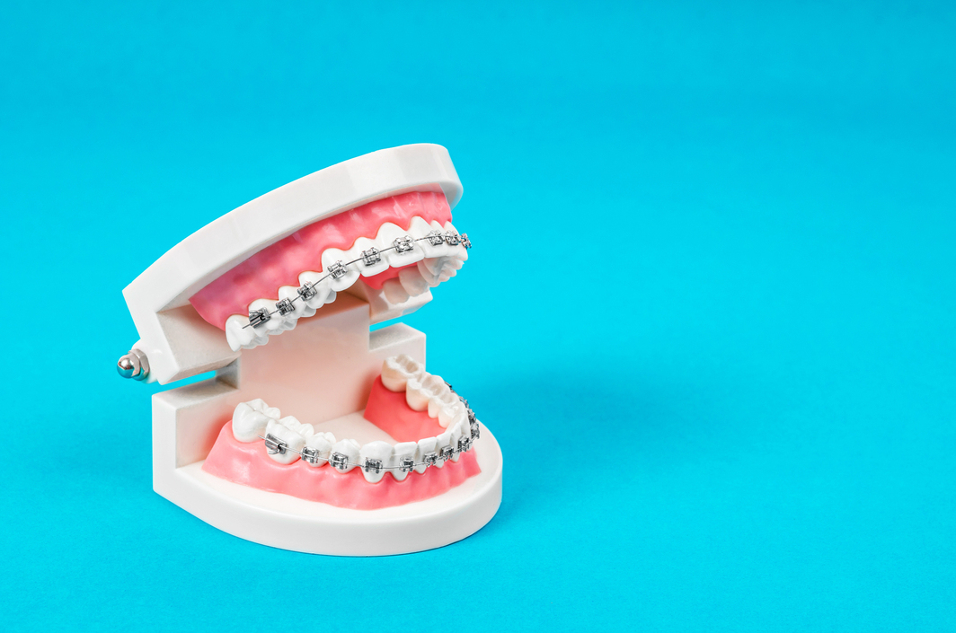 model with braces