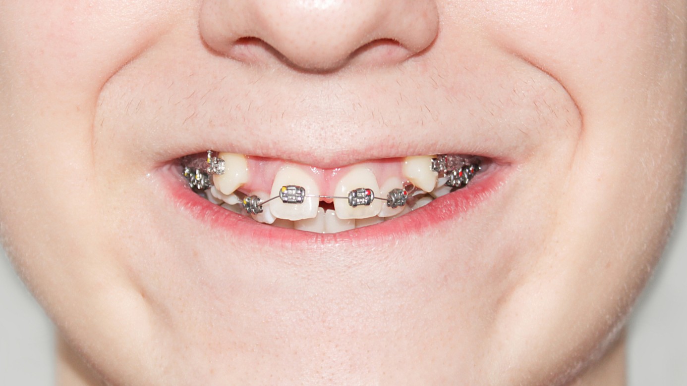 A close-up of a smiling mouth with braces installed on crooked teeth.