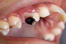 one tooth with severe decay