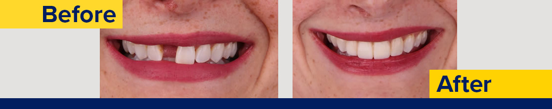 Before and after photos showing missing tooth fixed in the after photo