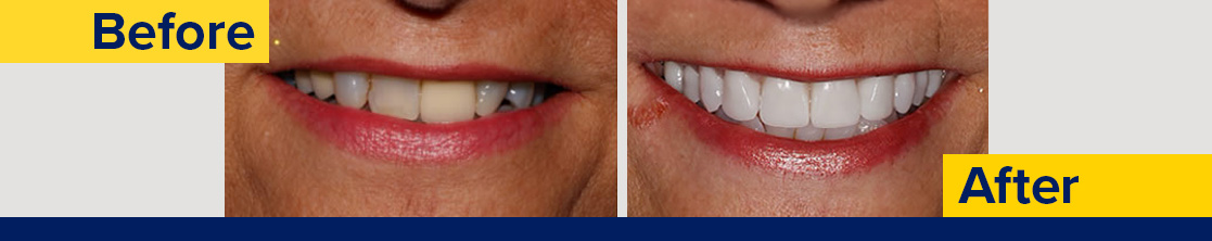 Before and after photos showing whiter straightened teeth on the after